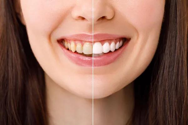 /img/32140-healthy-teeth.webp