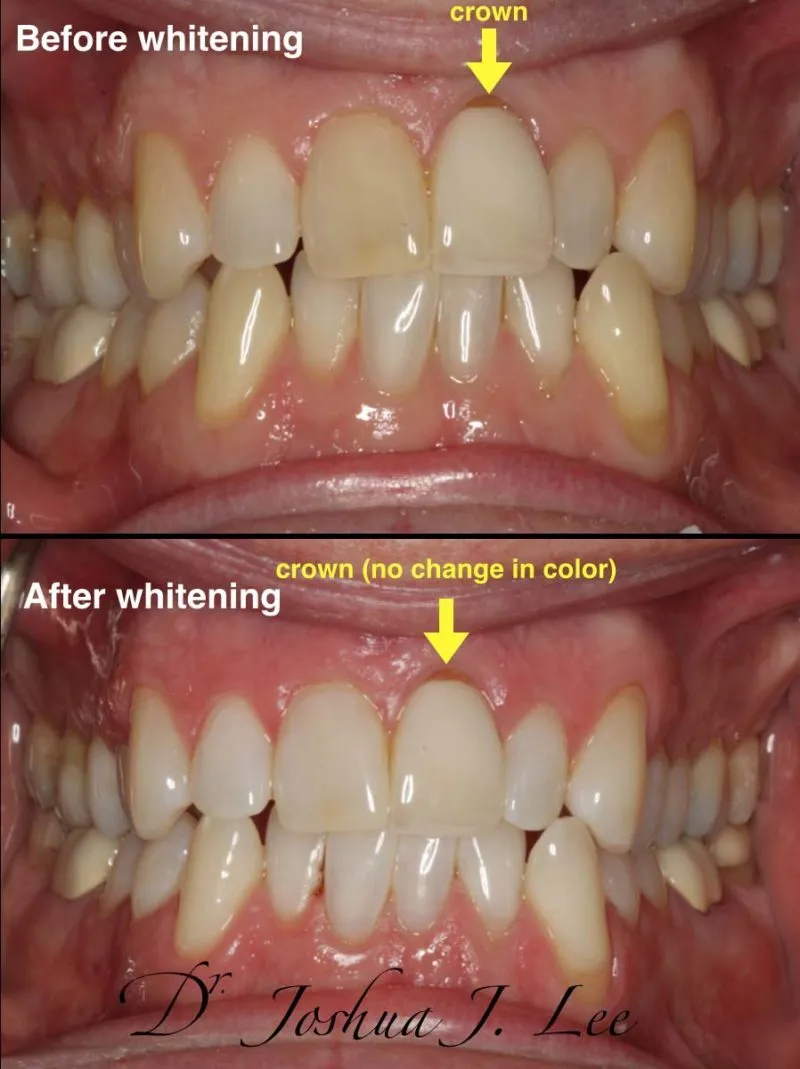 32149 zoom whitening santa barbara maintaining smile