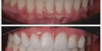 /img/32149-zoom-whitening-santa-barbara-professional-care.webp