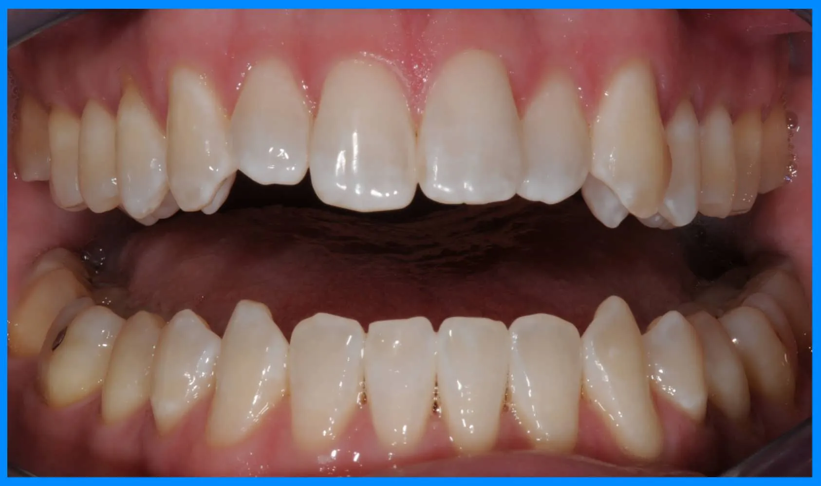 32149 zoom whitening santa barbara smile makeover