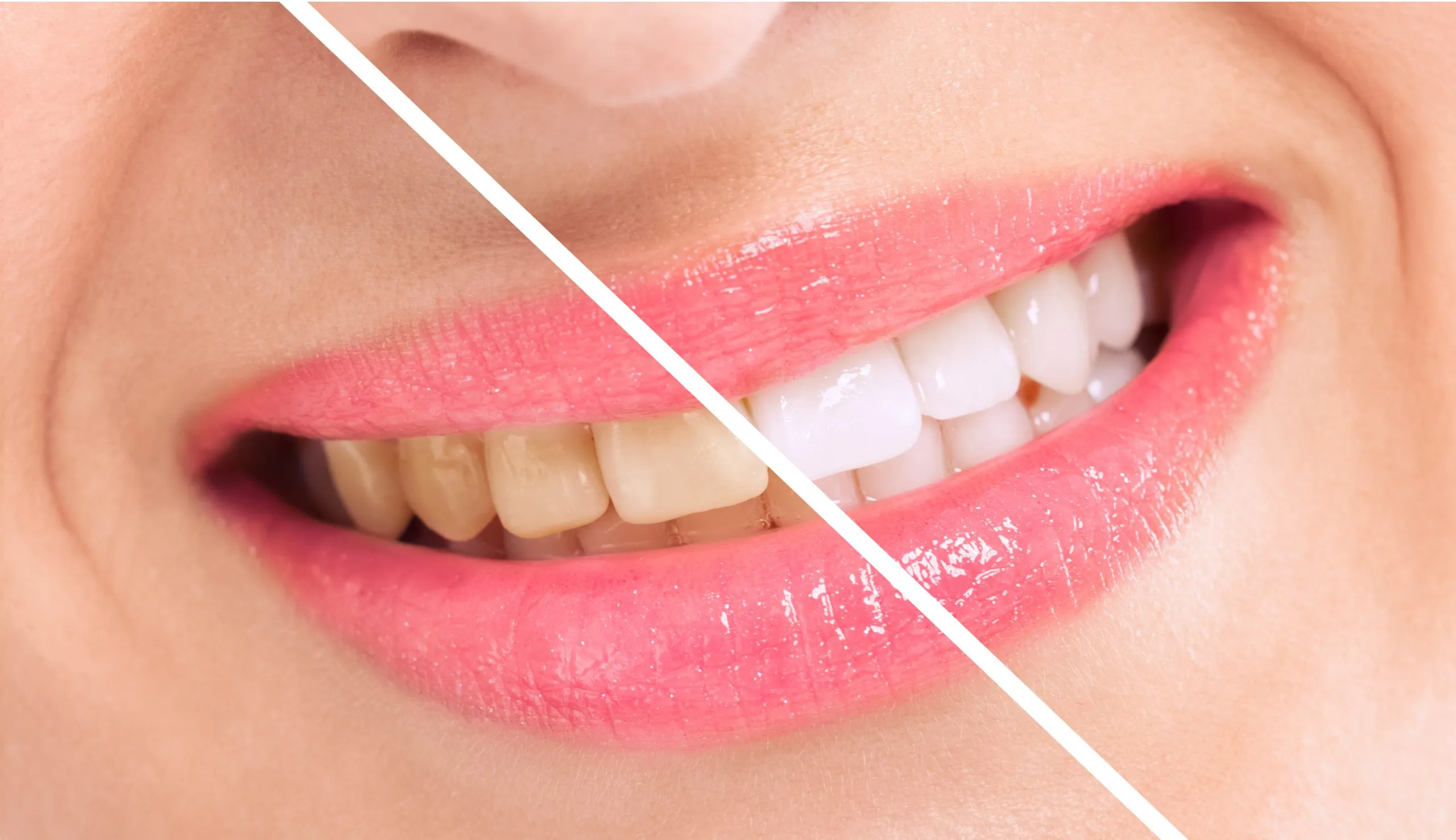 32150 at home teeth whitening