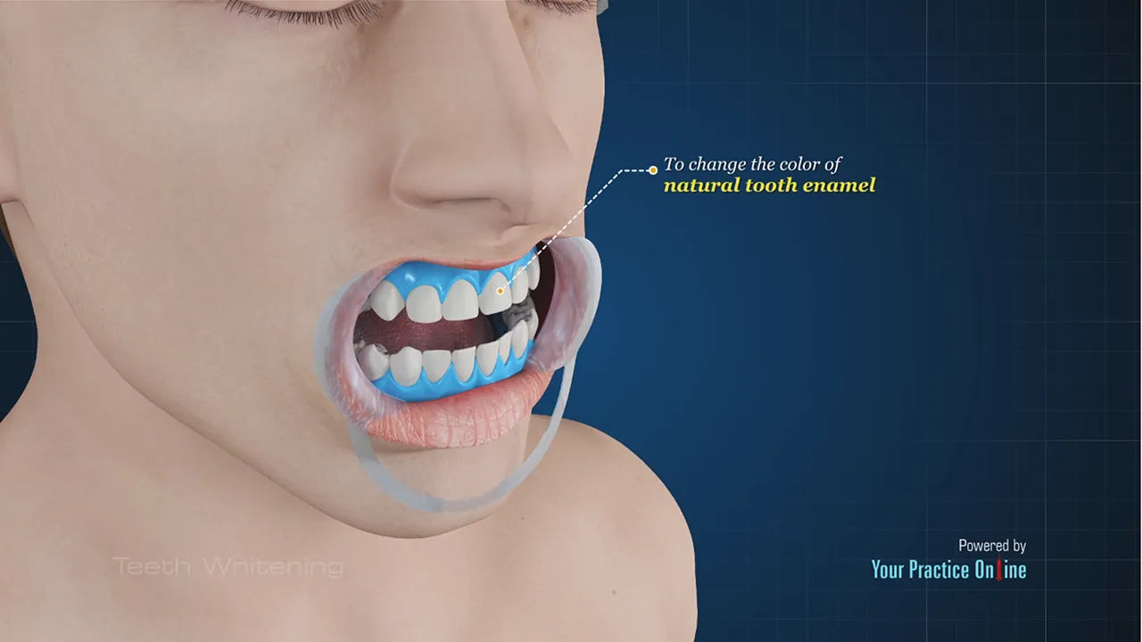 32150 teeth whitening care