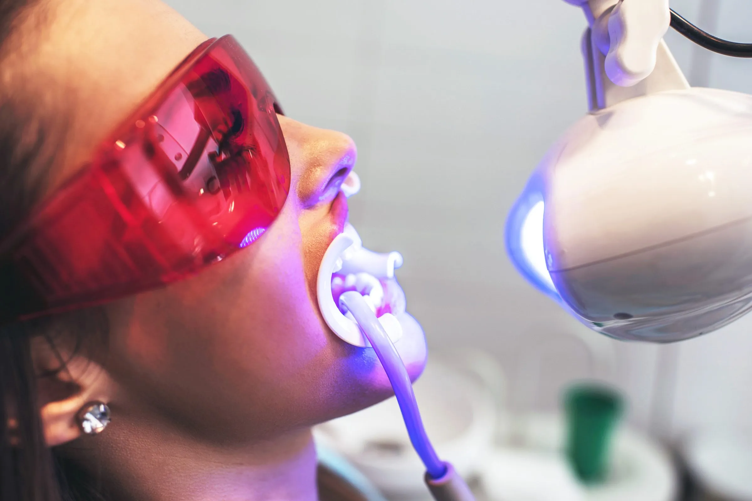 32150 teeth whitening cost