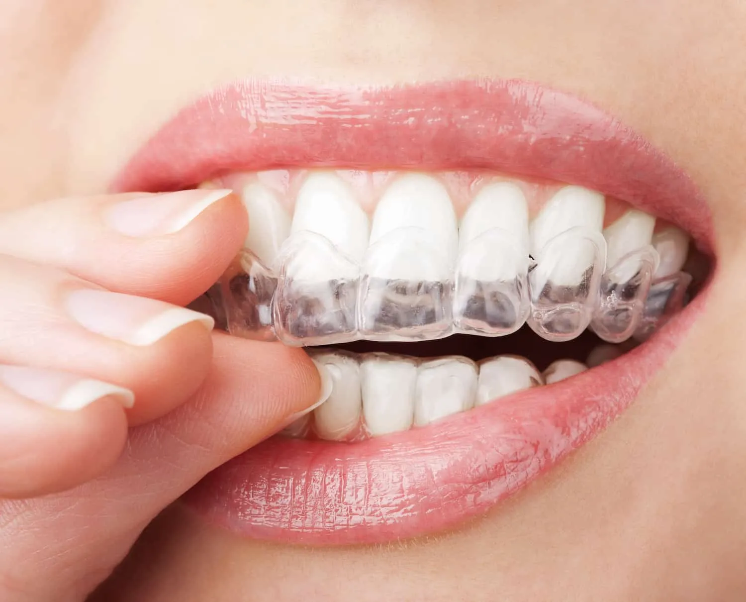 32152 at home teeth whitening