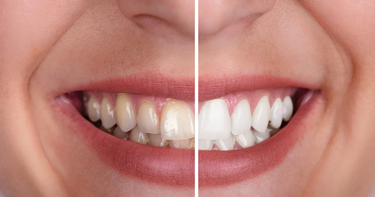 32152 in office teeth whitening