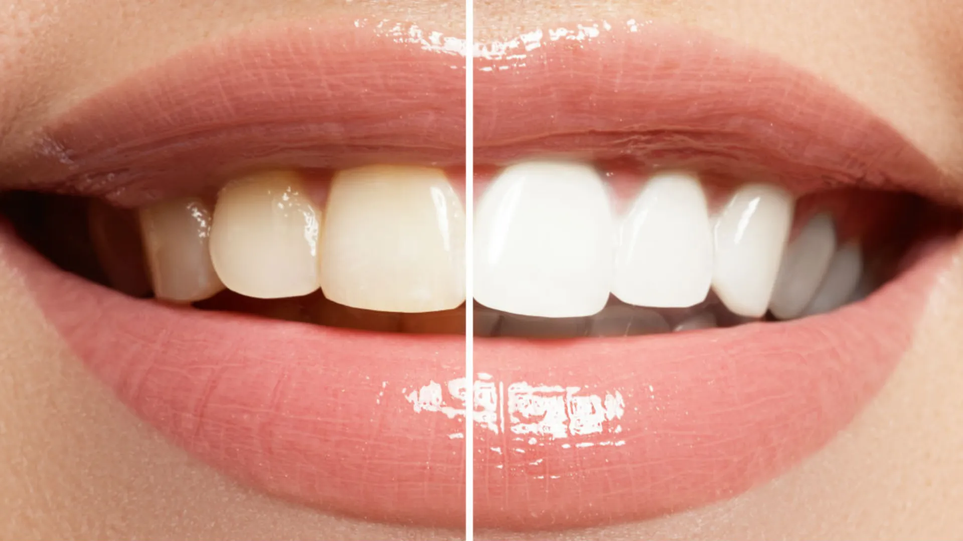 /img/32152-teeth-whitening-alternatives.webp