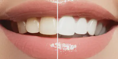 /img/32152-teeth-whitening-alternatives.webp
