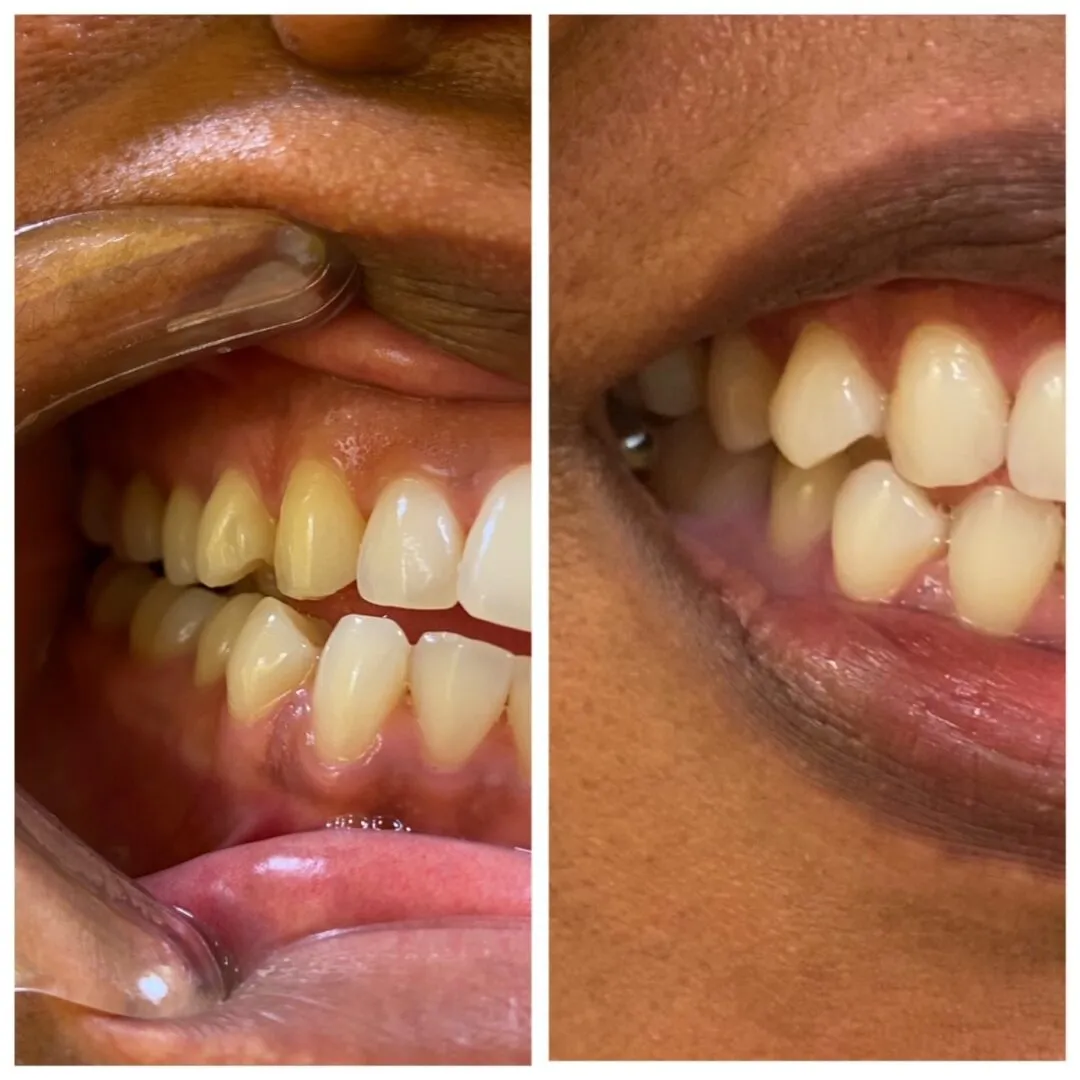 32154 at home teeth whitening