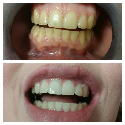 32154 teeth whitening kit types