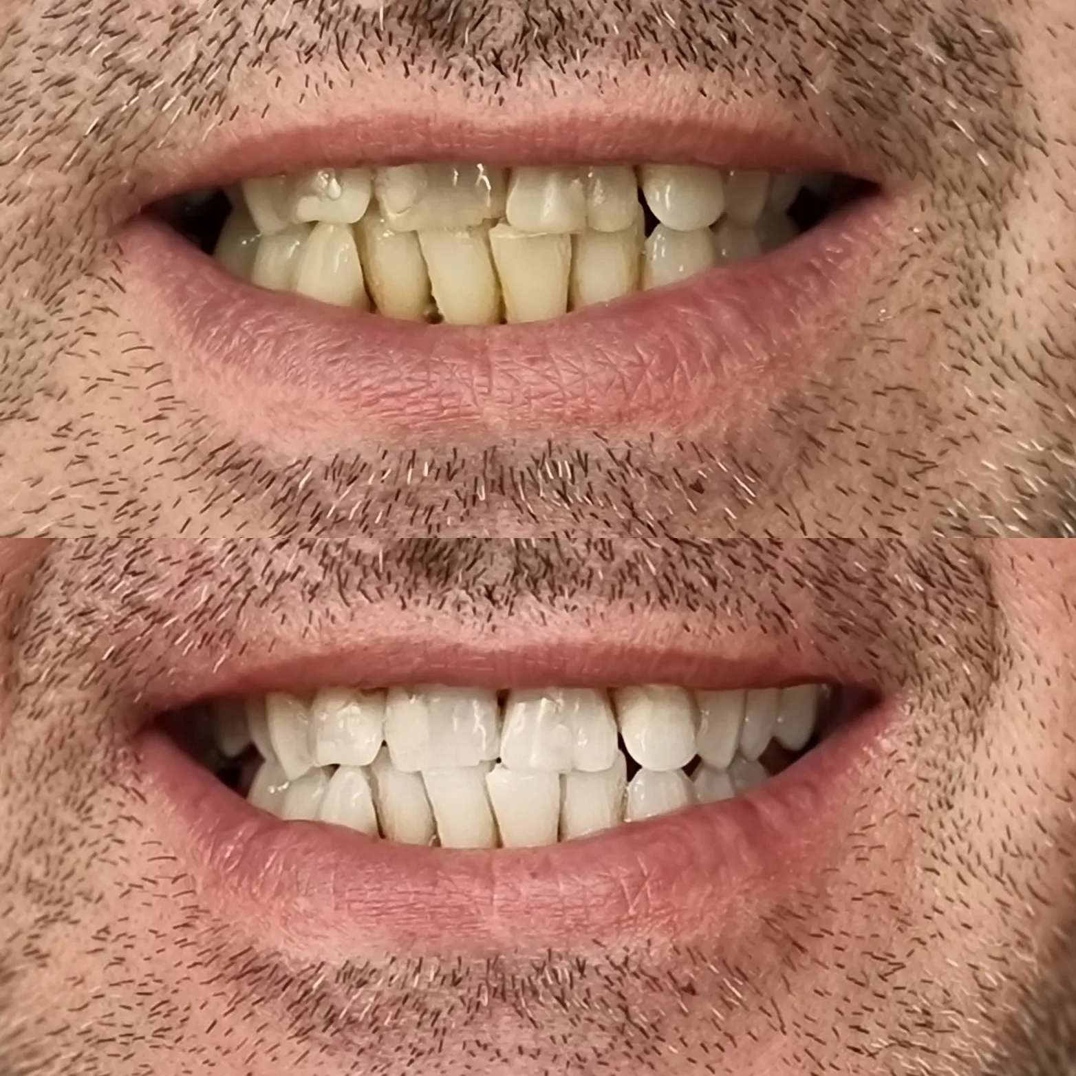 32156 teeth whitening melbourne 3