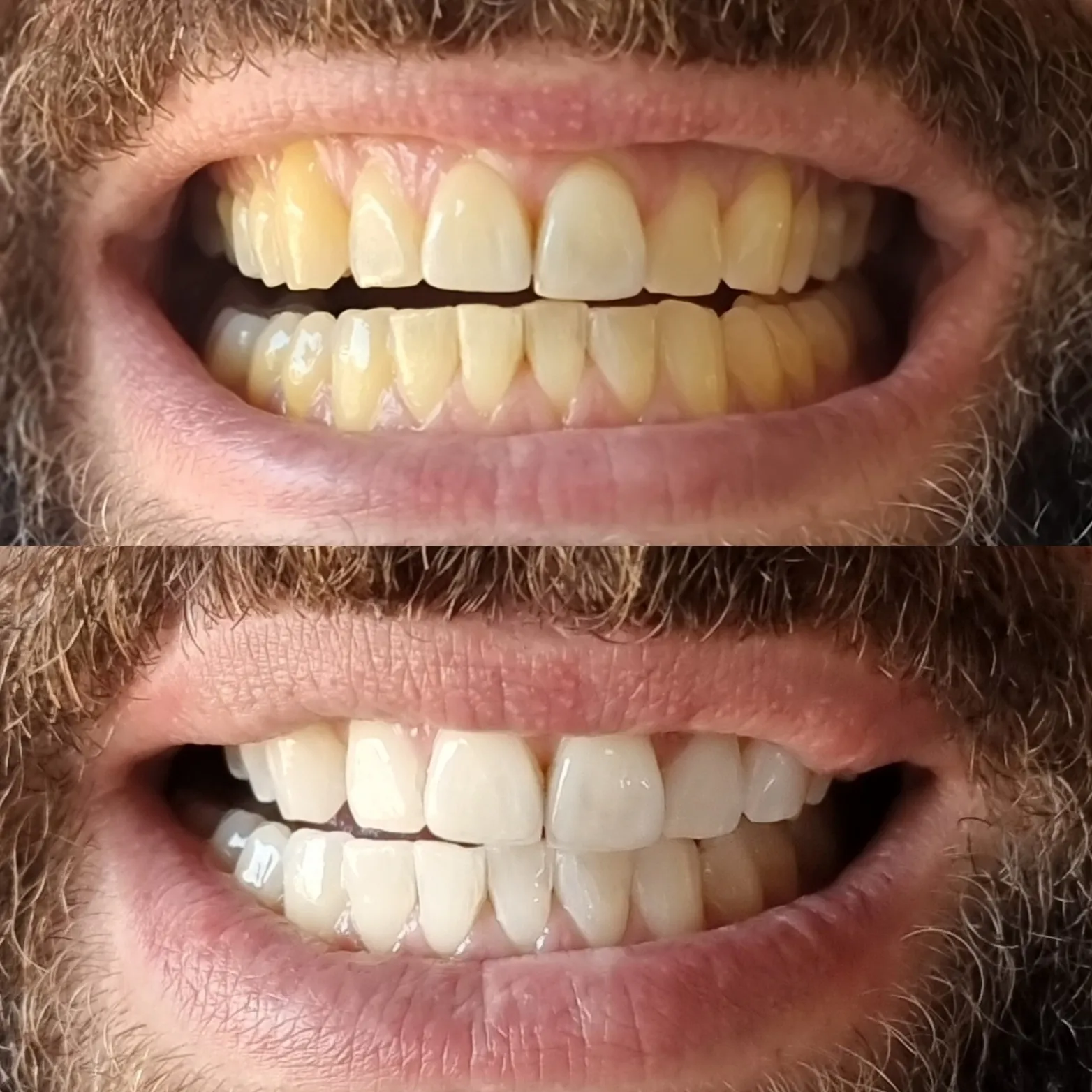 32156 teeth whitening melbourne 4
