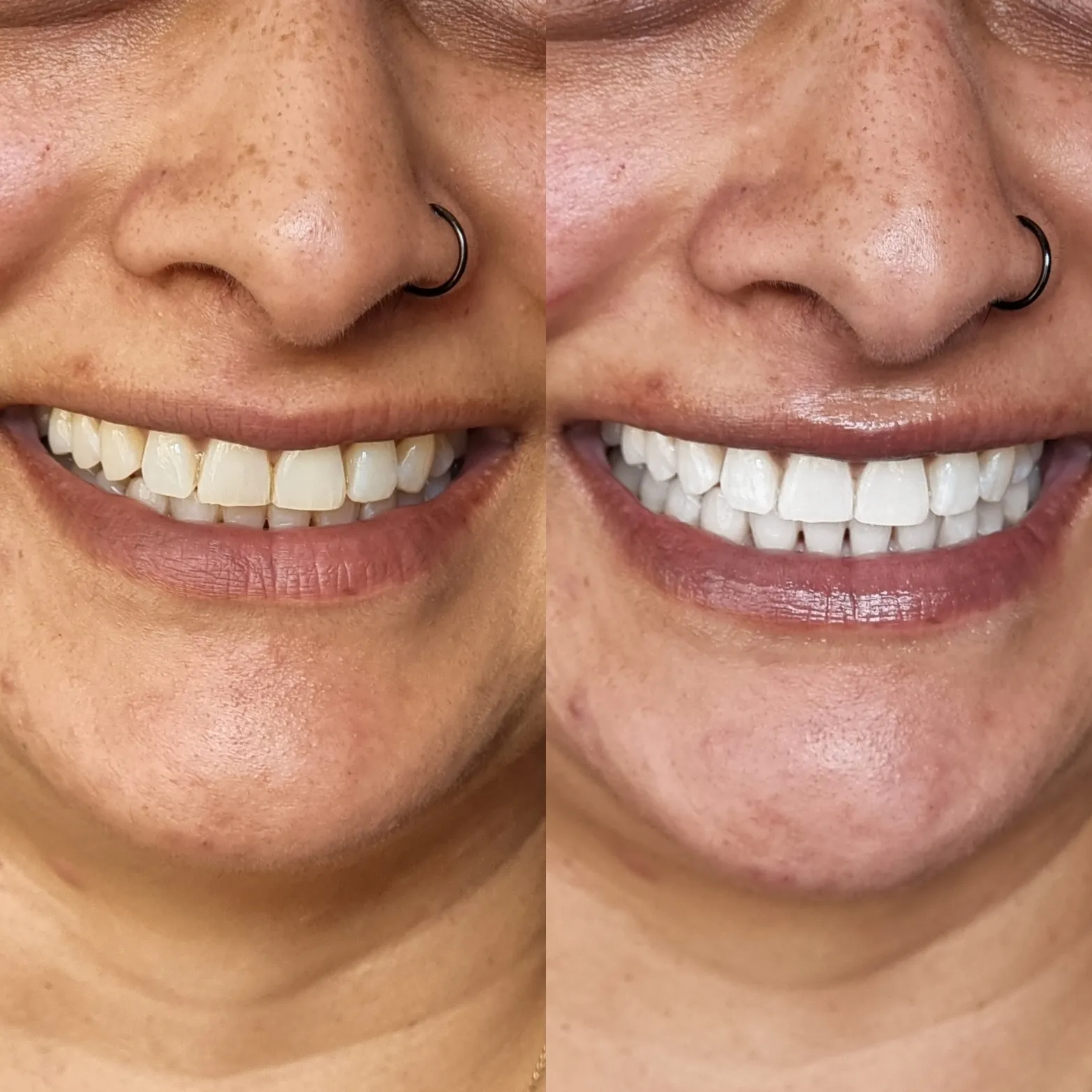 32156 teeth whitening melbourne 5