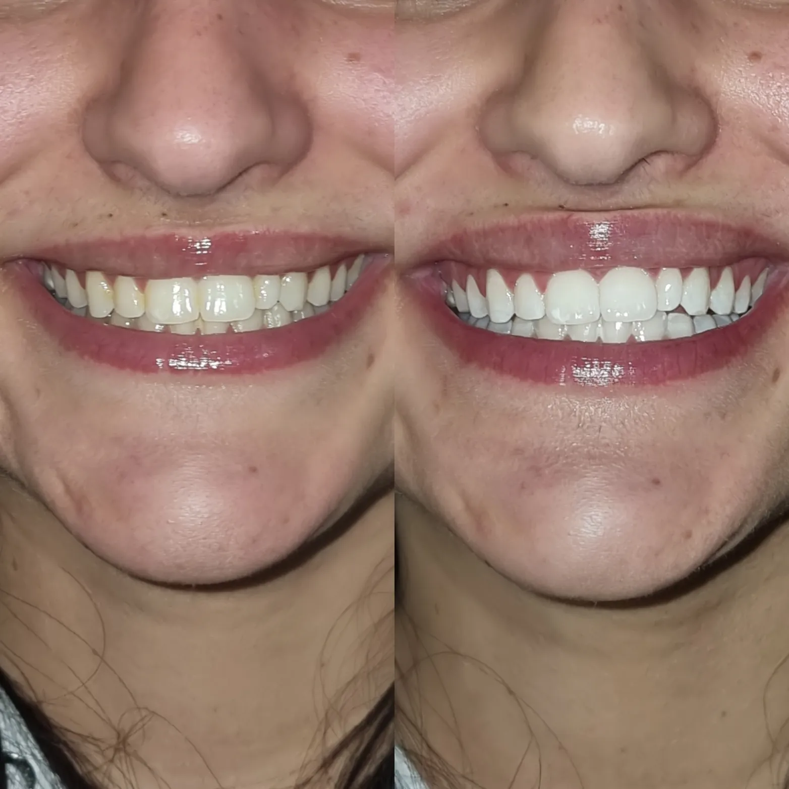 32156 teeth whitening melbourne 6
