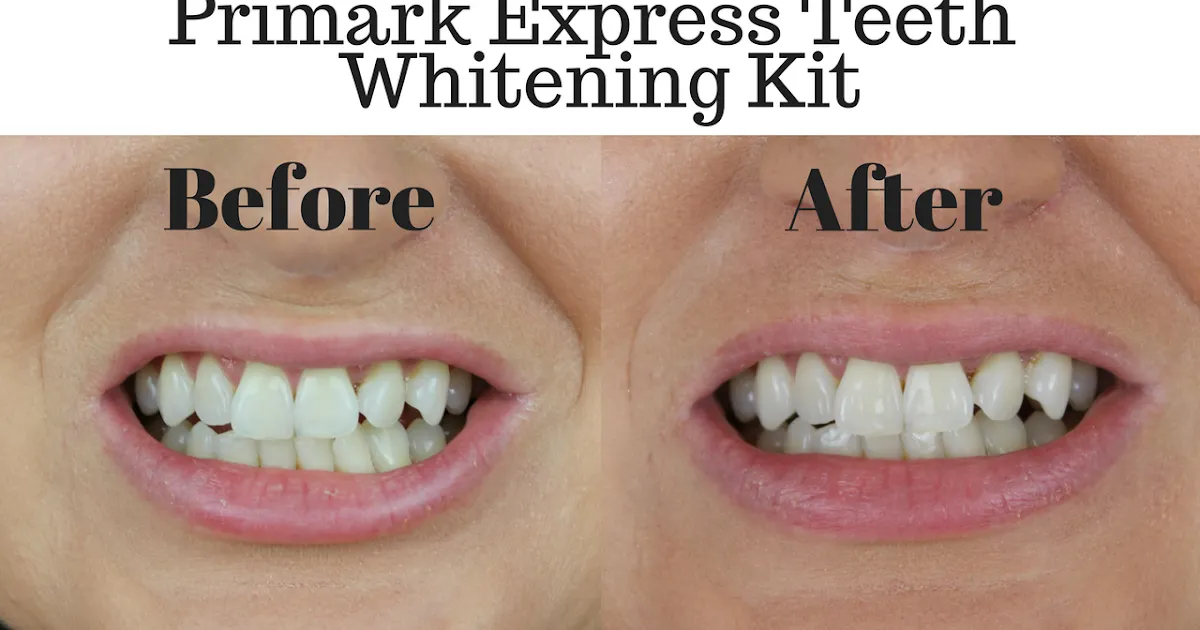 32162 teeth whitening application