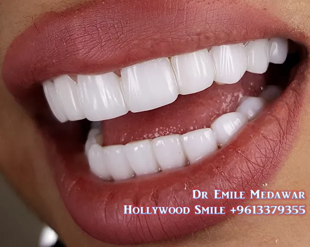 32162 teeth whitening gel options