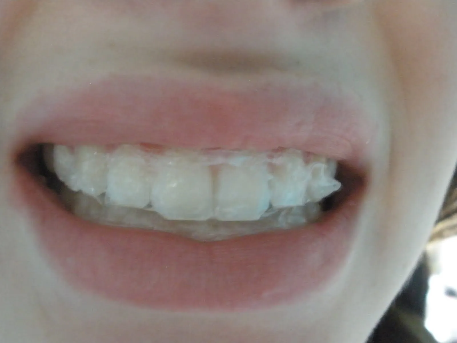 32166 teeth before after whitening