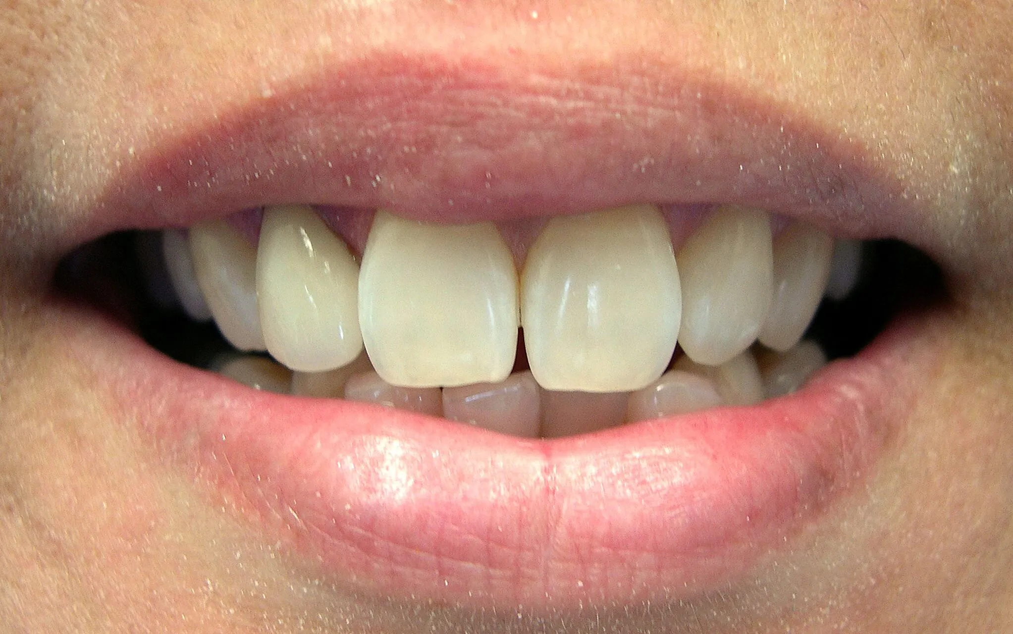 32169 custom whitening trays