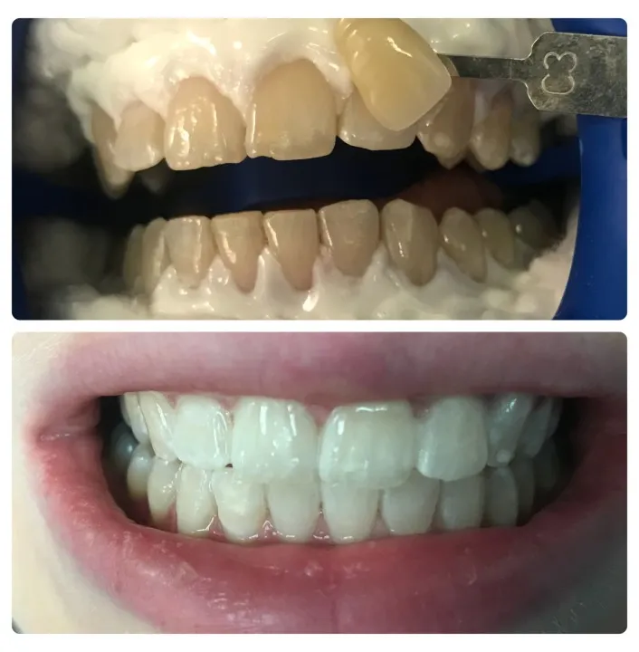 32171 at home teeth whitening kits