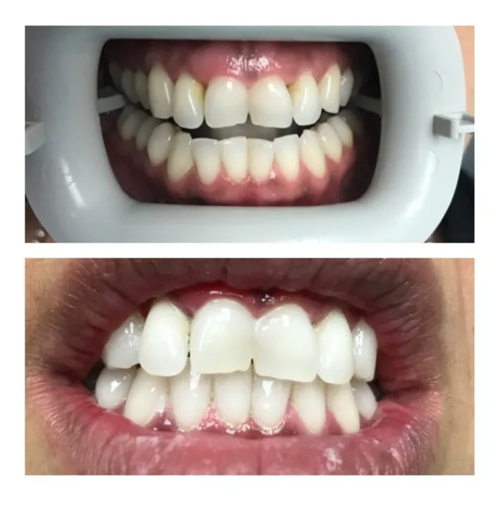 32171 teeth whitening confidence