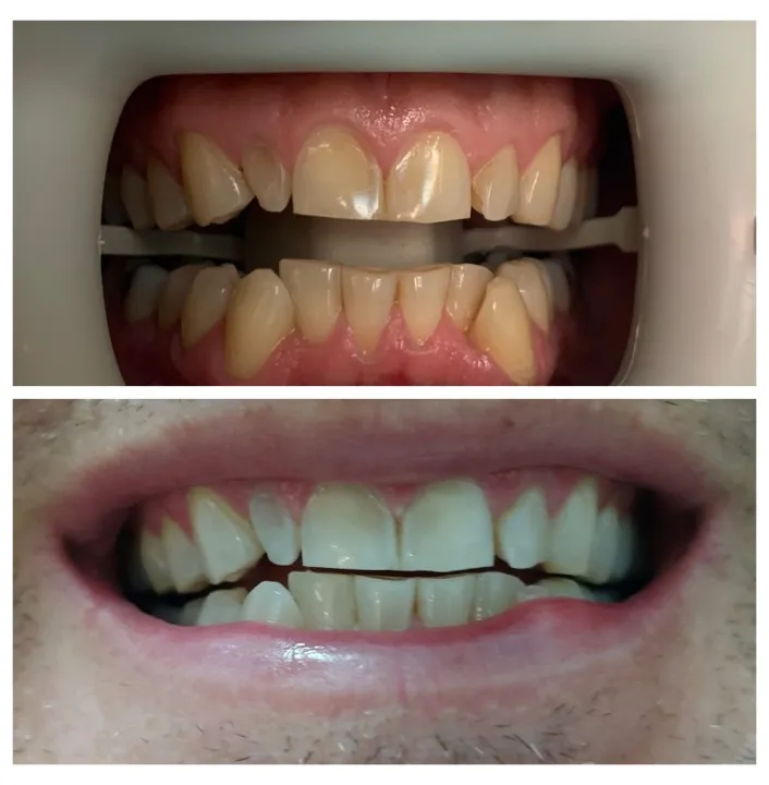 32171 teeth whitening smile