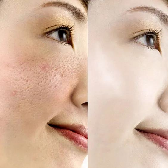 32175 chemical peels skin