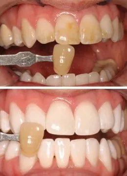 32178 teeth whitening in office