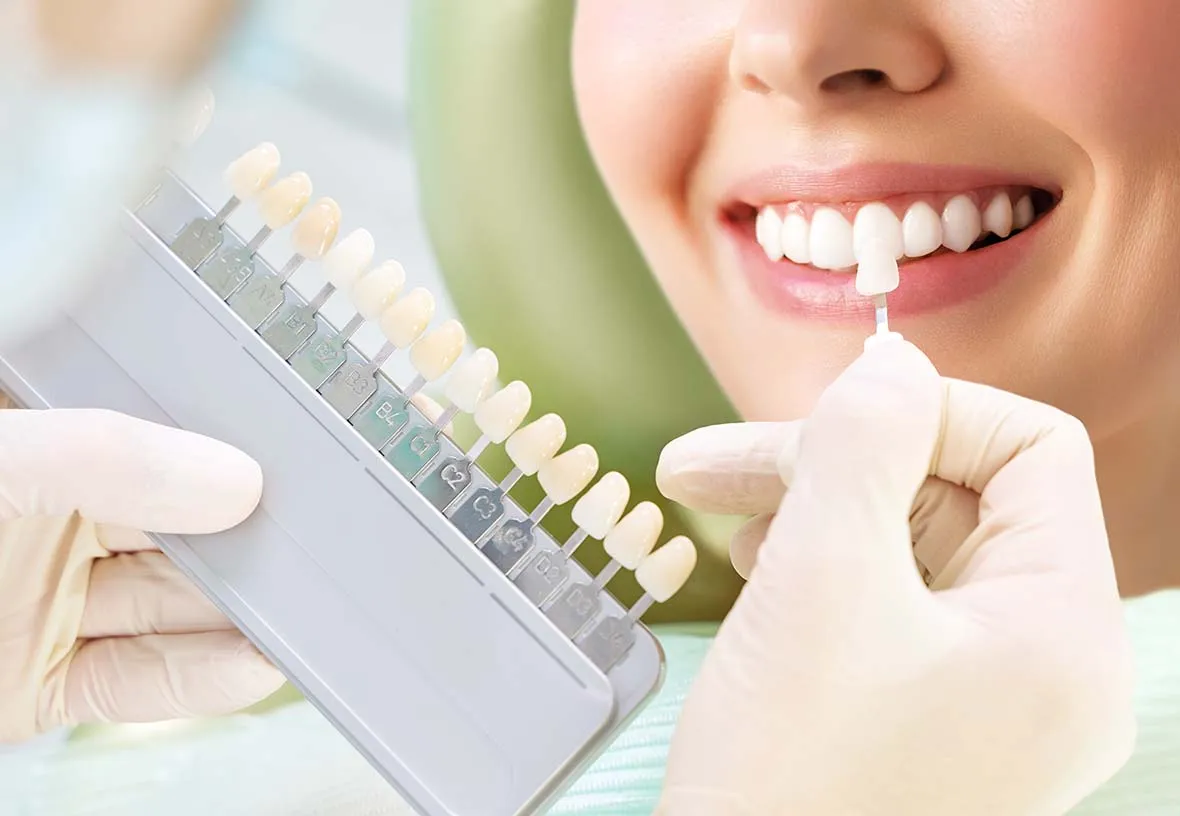 32180 teeth whitening results