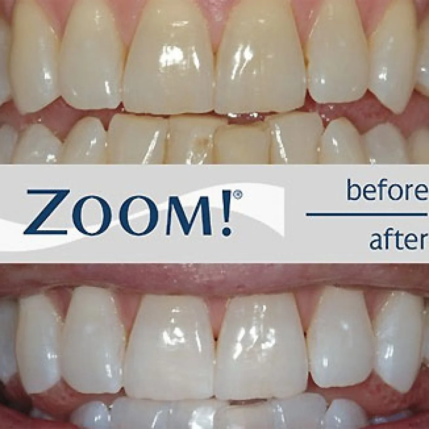 32184 zoom teeth whitening nyc 1