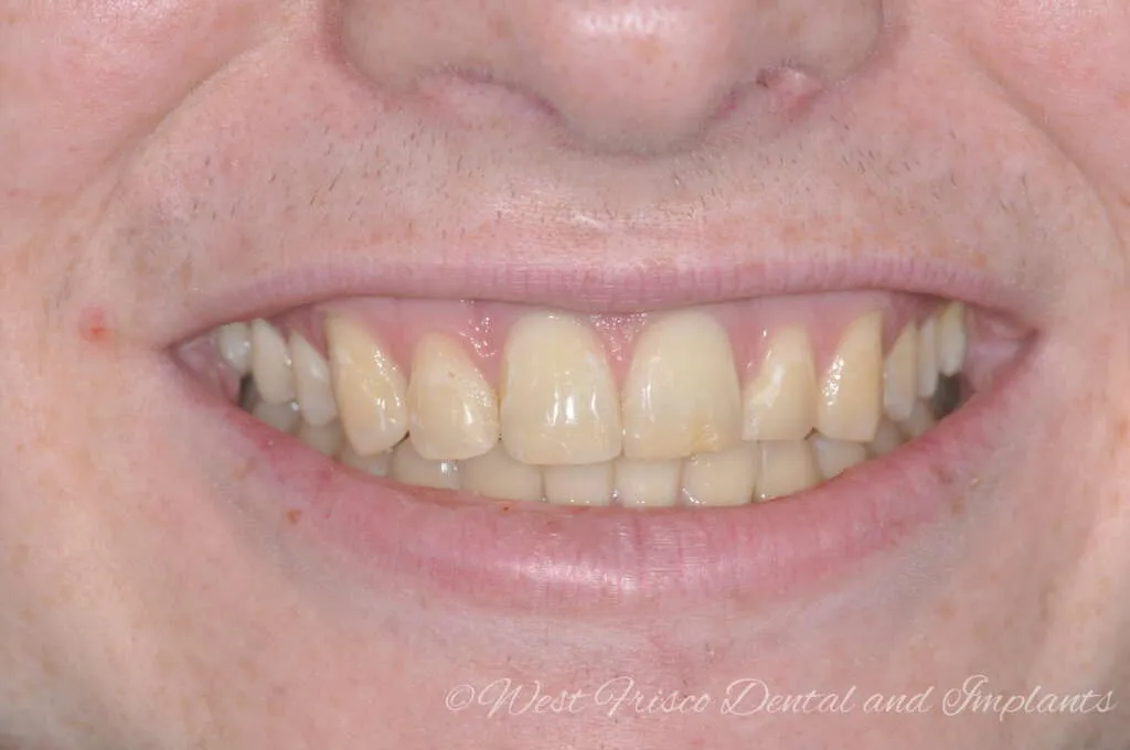 32184 zoom teeth whitening nyc 5