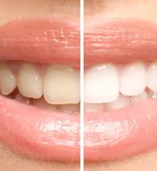 32187 professional teeth whitening