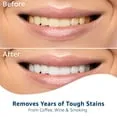 /img/32190-invisalign-whitening-strips-8.webp