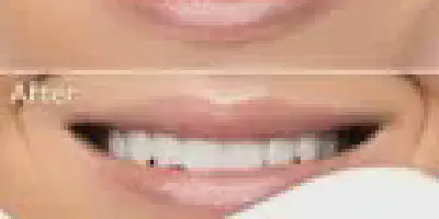 /img/32190-invisalign-whitening-strips-8.webp