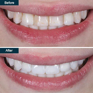 /img/32193-post-whitening-care.webp