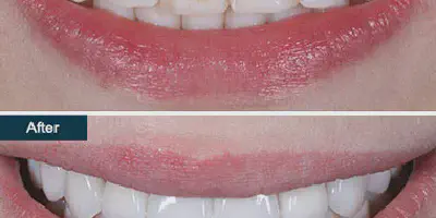 /img/32193-post-whitening-care.webp