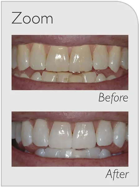 32193 sensitive teeth