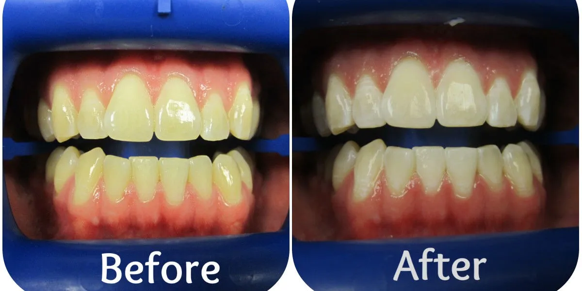 32193 tooth enamel