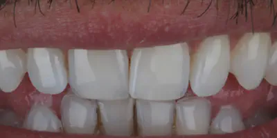 /img/32194-smile-with-white-teeth.webp