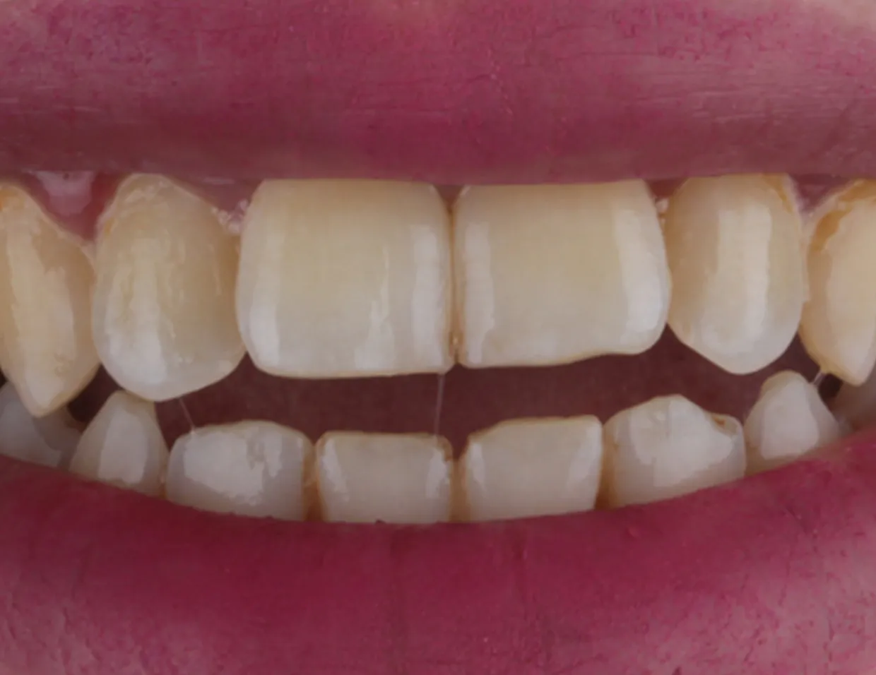 32194 teeth whitening before after