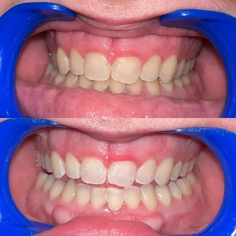 32196 customized teeth whitening