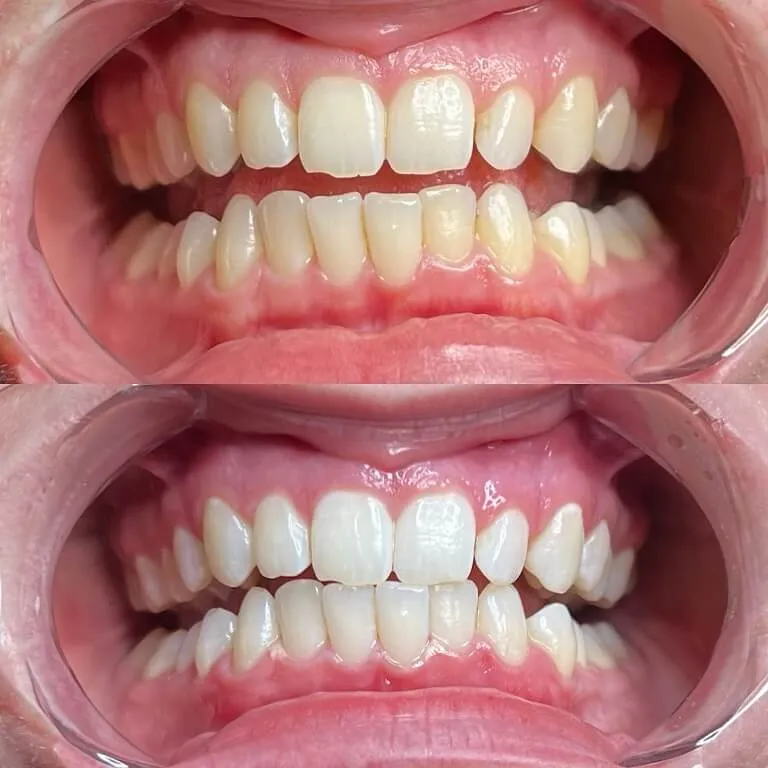 32196 faster teeth whitening