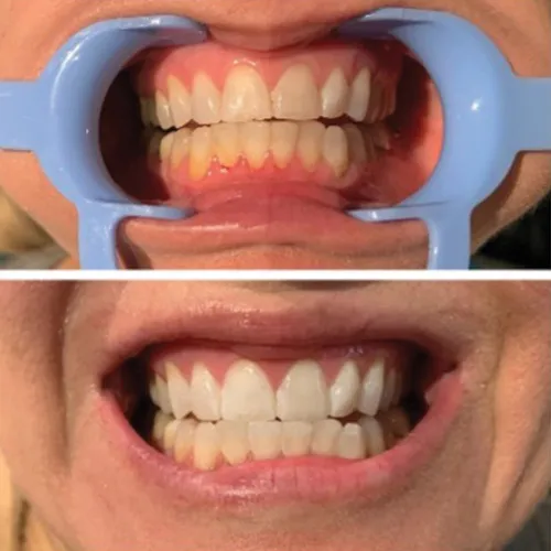 32196 long lasting results teeth