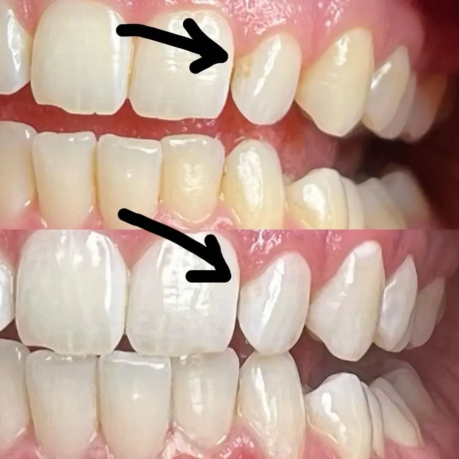 32196 teeth whitening agents