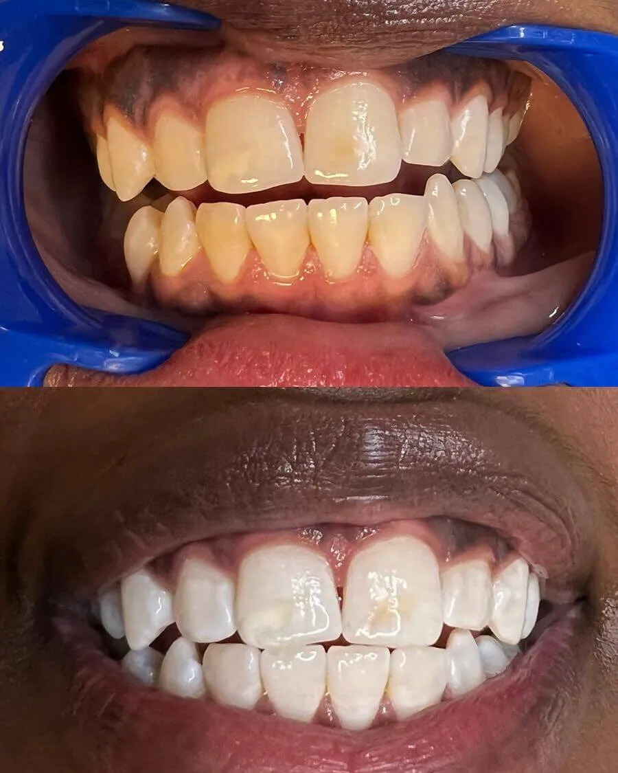32196 teeth whitening process