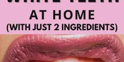 /img/32197-teeth-whitening-image7.webp