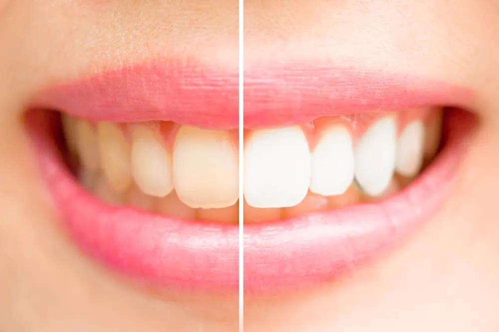 32208 teeth whitening columbus ga home kits