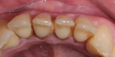 /img/32210-extending-whitening-results.webp