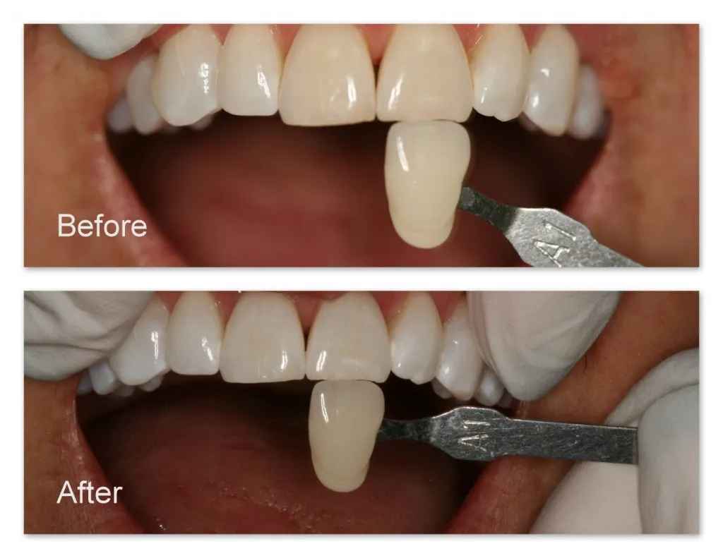 32210 post whitening care