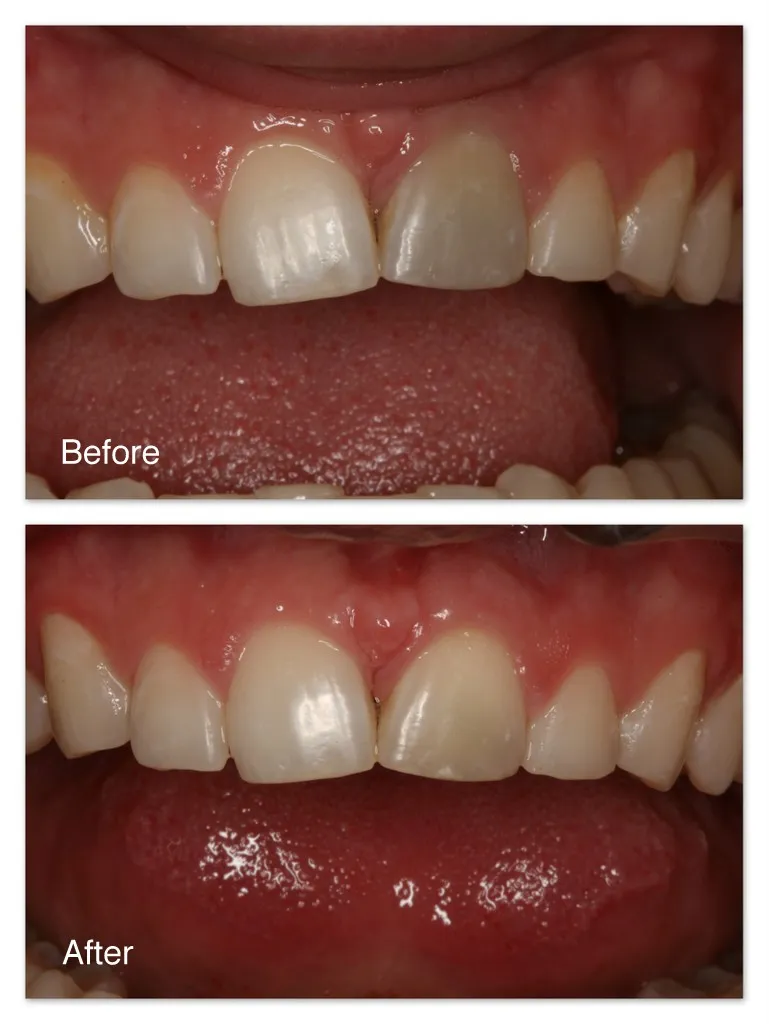 32210 teeth whitening diet