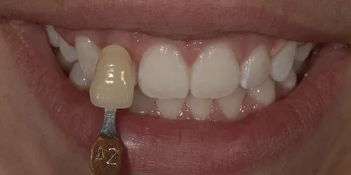 32211 avoid teeth staining foods