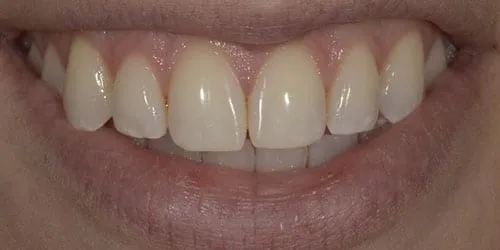 32211 good oral hygiene